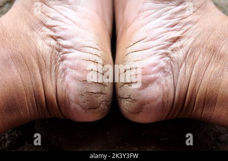 Talons secs et fissurés en raison du manque d'humidité dans les pieds Banque D'Images