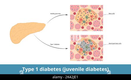 Diabète de type 1 (diabète juvénile). Le diabète sucré de type 1 provient de la destruction des cellules bêta pancréatiques. Cellules β détruites dans le pancréas Illustration de Vecteur