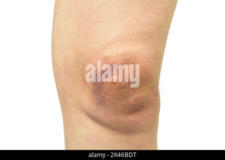 Violence domestique blessure sur la jambe isolée sur fond blanc avec un chemin de coupure Banque D'Images