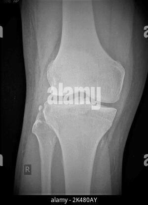 Fracture de Segond, rayons X. Banque D'Images