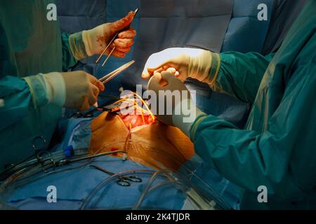 Chirurgie cardiaque ouverte en raison d'un dysfonctionnement de la valve cardiaque, remplacement de la valve Banque D'Images