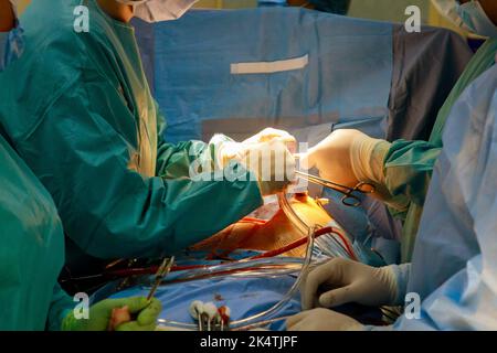 Une chirurgie à cœur ouvert est effectuée dans la salle d'opération en cas de dysfonctionnement de la valve cardiaque, qui nécessite le remplacement de la valve. Banque D'Images