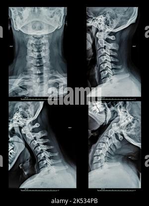 Les rayons X du cou, les disques et les os du cou, la tête et le crâne humain détaillent toutes les formes Banque D'Images