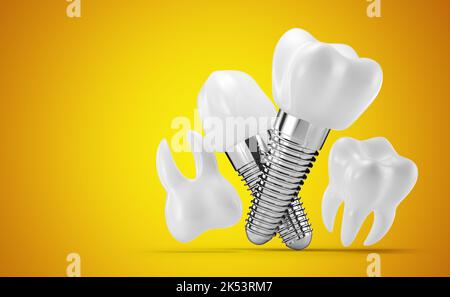 implants dentaires sur fond jaune. 3d rendu, 3d illustration. Banque D'Images