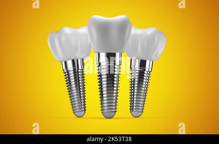 implants dentaires sur fond jaune. 3d rendu. Banque D'Images