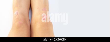 Arthrite psoriasique avec psoriasis cutané sur les genoux d'une femme. Liquide synovial chez un patient atteint de psoriasis de l'articulation gauche du genou. Arthrite inflammatoire Banque D'Images