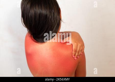 Dos de la longue fille aux cheveux avec de graves brûlures rouges après avoir passé du temps au soleil, fond gris. L'enfant frotte après la crème solaire avec la main sur les zones enflammées de Banque D'Images