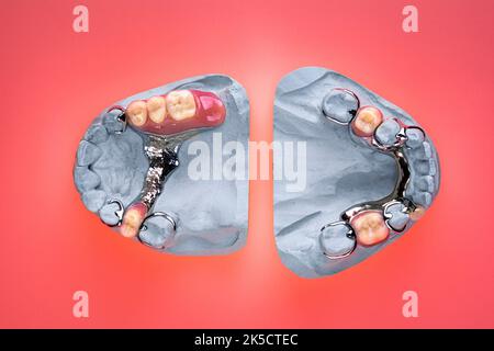 Prothèses dentaires, prothèses partielles sur le modèle de plâtre Banque D'Images