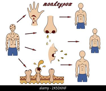 Méthodes d'infection humaine par la variole du singe. Schéma de la transmission de la variole de l'homme à l'homme. Illustration à vecteur de couleur. Illustration de Vecteur