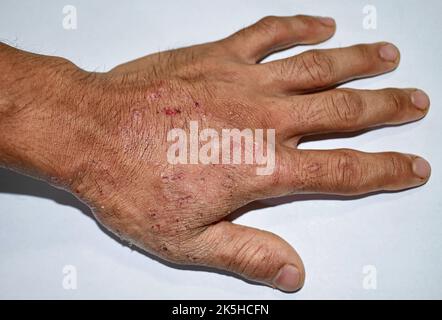 Démangeaisons de la peau lésions dans la main de l'homme adulte asiatique. Elle peut être causée par une infestation de gale ou une infection fongique. Banque D'Images