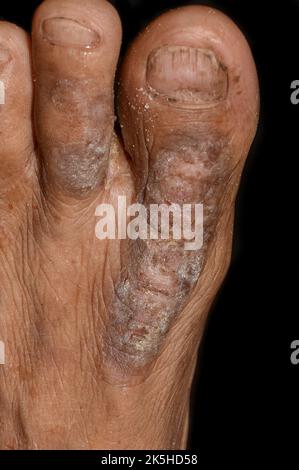 Eczéma ou infection fongique au pied de l'homme asiatique. Vue en gros plan. Banque D'Images