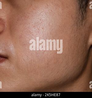 Visage huileux avec de larges pores de l'Asie du Sud-est, du Myanmar ou de l'adulte coréen jeune homme. Banque D'Images