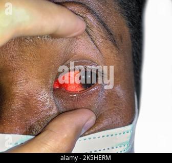 Infection cornéenne ou ulcère appelé kératite chez la vieille femme asiatique. Banque D'Images