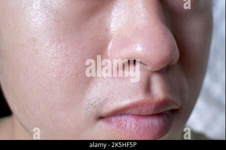 Peau équitable avec de larges pores sur le visage huileux du jeune homme adulte d'Asie du Sud-est, du Myanmar ou de Corée. Banque D'Images