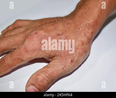 Démangeaisons de la peau lésions dans la main de l'homme adulte asiatique. Elle peut être causée par une infestation de gale ou une infection fongique. Banque D'Images