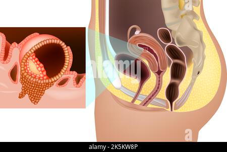 Implantation de l'ovule fécondé dans l'utérus. Embryon humain implanté dans l'utérus. Développement prénatal Illustration de Vecteur