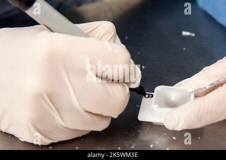 Scientifique préparant des blocs de paraffine contenant des tissus de biopsie pour la coupe. Laboratoire de pathologie. Diagnostic du cancer. Banque D'Images