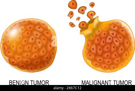 Cellules cancéreuses dans les tumeurs bénignes et malignes. Gros plan des carcinocytes qui ont la capacité de métastase (droite). Cellules non cancéreuses Illustration de Vecteur