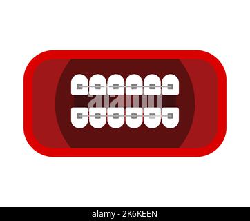 Bouche avec bretelles isolées. correction de l'occlusion et des dents tordues Illustration de Vecteur