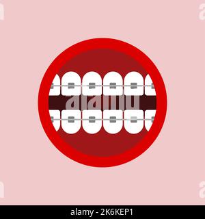 Bouche avec bretelles isolées. correction de l'occlusion et des dents tordues Illustration de Vecteur