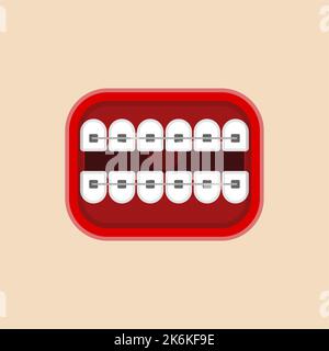 Bouche avec bretelles isolées. correction de l'occlusion et des dents tordues Illustration de Vecteur