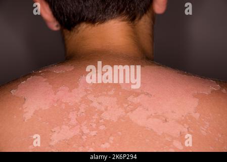 La peau délicate d'un enfant de 11 ans brûlé par le soleil. Concept de dommages causés par les rayons ultraviolets du soleil. Effet des rayons UVA et UVB. Banque D'Images