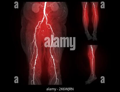 Prélèvement de l'artère fémorale CTA au large de l'artère fémorale présentant une maladie artérielle périphérique aiguë ou chronique. Banque D'Images