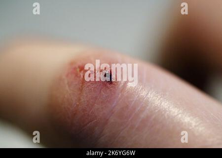 Marque de morsure de chien sur l'index d'une femme blanche. Il y a un peu de gonflement, rougeur, ecchymoses, sang sec et début d'un eschar. Macro médical eux Banque D'Images