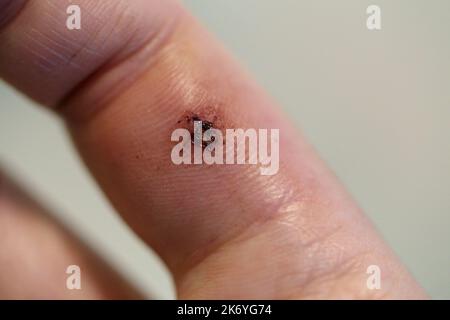 Marque de morsure de chien sur l'index d'une femme blanche. Il y a un peu de gonflement, rougeur, ecchymoses, sang sec et début d'un eschar. Macro médical eux Banque D'Images