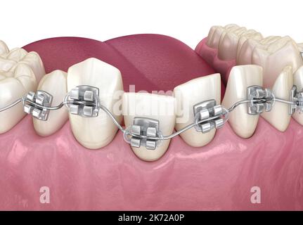 Position anormale des dents et trétament des accolades. Illustration dentaire 3D précise sur le plan médical Banque D'Images