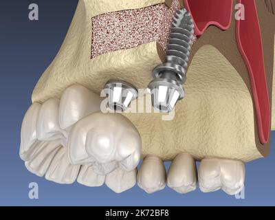 La chirurgie d'ascenseur de sinus - installation de l'implant. 3D illustration Banque D'Images