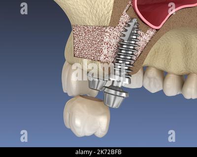 La chirurgie d'ascenseur de sinus - installation de l'implant. 3D illustration Banque D'Images