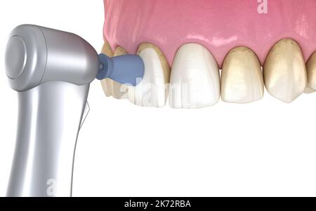 Procédure de polissage des dents avec brosse professionnelle et gel. Illustration 3D précis médicalement Banque D'Images