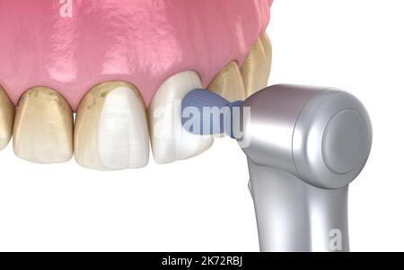 Procédure de polissage des dents avec brosse professionnelle et gel. Illustration 3D précis médicalement Banque D'Images