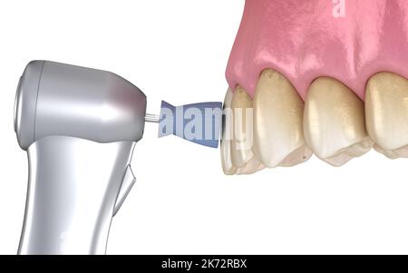 Procédure de polissage des dents avec brosse professionnelle et gel. Illustration 3D précis médicalement Banque D'Images