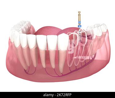 Processus de traitement des canaux racinaires endodontiques. Illustration de la dent 3D médicalement précise. Banque D'Images