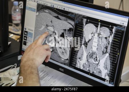 Chirurgie robotique à l'hôpital Lyon Sud - salle d'opération pendant la chirurgie robotique à l'hôpital Lyon Sud. Le patient atteint du syndrome de 'nutcracker' subit une greffe de rein entièrement réalisée par un chirurgien aux commandes d'un robot chirurgical.©PHOTOPQR/LE PROGRES/photo Maxime JEGAT - opération chirurgicale robotisée à l'hôpital Lyon Sud -le Dr Sébastien Crouzet, chirurgie à l'hôpital Sud Lyon, scan to the ope scanning the opuration murgicale robot as to il va mener. La patiente, attestation du syndrome de 'casse-noisette', subie une auto greffe of rein en Banque D'Images