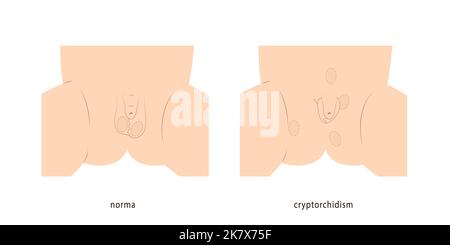 Illustration médicale du scrotum du petit garçon en bonne santé et avec des testicules non descendants démontrant l'emplacement possible des testicules. Illustration de Vecteur