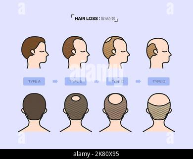 infographie sur le traitement, la prévention et la transplantation de la perte de cheveux Banque D'Images