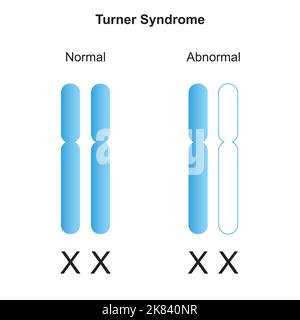 Conception scientifique du syndrome de Turner (monosomie X). Symboles colorés. Illustration vectorielle. Illustration de Vecteur