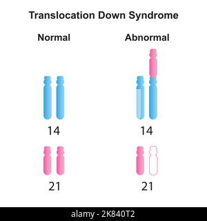 Conception scientifique du syndrome de translocation vers le bas de Robertsonian. Symboles colorés. Illustration vectorielle. Illustration de Vecteur