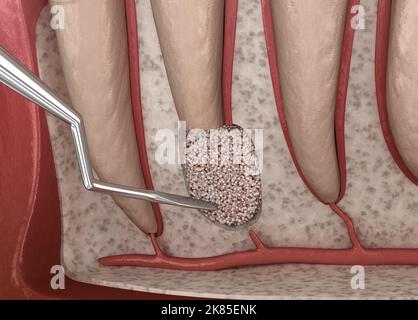 Chirurgie de cystectomie dentaire - récupération après périostite . Illustration 3D médicale précise Banque D'Images