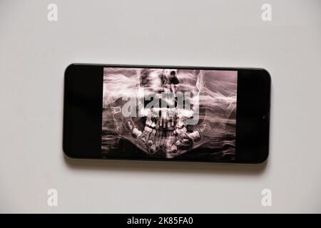 La prise de vue panoramique montre plusieurs dents incrustées et impactées sur la mâchoire supérieure et inférieure des dents des enfants sur les écrans du téléphone, application mobile Banque D'Images