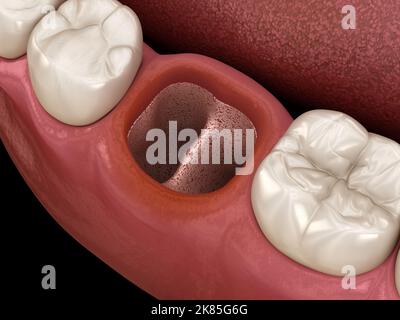 Alveolits - cercueil sec ouvert après extraction de dent. Illustration 3D médicale précise Banque D'Images