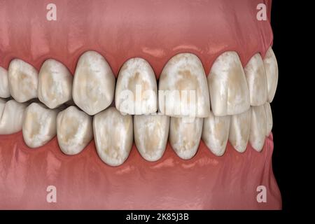 Déminéralisation des dents, élimination des minéraux des tissus durs : émail, dentine et cémétu. Illustration 3D médicale précise. Banque D'Images