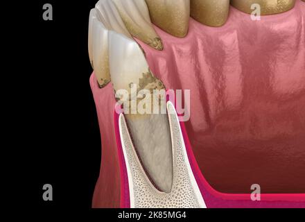 Parodontite stade 1, récession gingivale, tartre. Illustration 3D médicale précise Banque D'Images