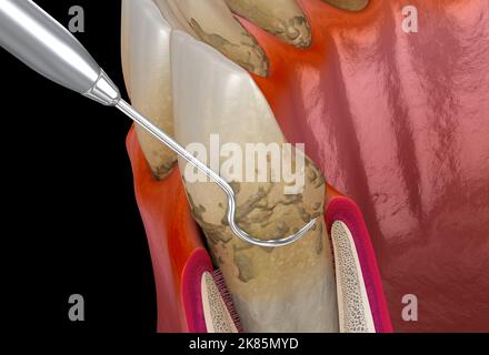 Hygiène bucco-dentaire : détartrage et plantage des racines de la parodontite de stade 2 (thérapie parodontale conventionnelle). 3D illustration médicale précise des dents humaines Banque D'Images