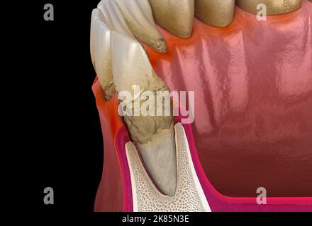 Parodontite stade 3, récession gingivale, tartre. Illustration 3D médicale précise Banque D'Images