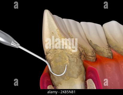 Hygiène bucco-dentaire : détartrage et plantage des racines de la parodontite de stade 3 (thérapie parodontale conventionnelle). 3D illustration médicale précise des dents humaines Banque D'Images