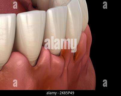 Gingivite inflammation des gencives. Illustration 3D médicale précise Banque D'Images